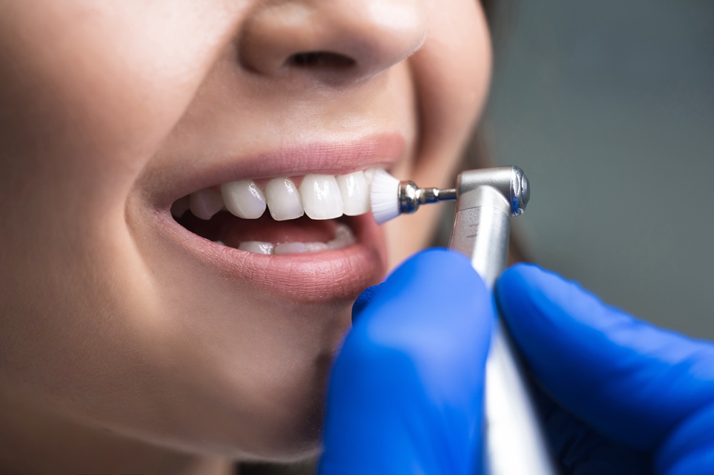 Close-up of teeth being polished with a dental cleaning tool, highlighting effective plaque removal and bright results from San Diego teeth cleaning - San Diego Teeth Cleaning